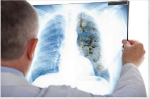 A doctor looking at an xray of a pair of lungs,, one healthy lung one unhealthy