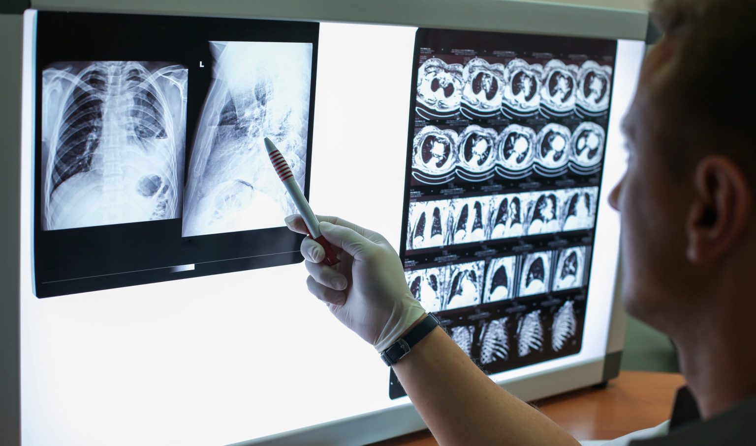 doctor examining an x-ray of the lungs